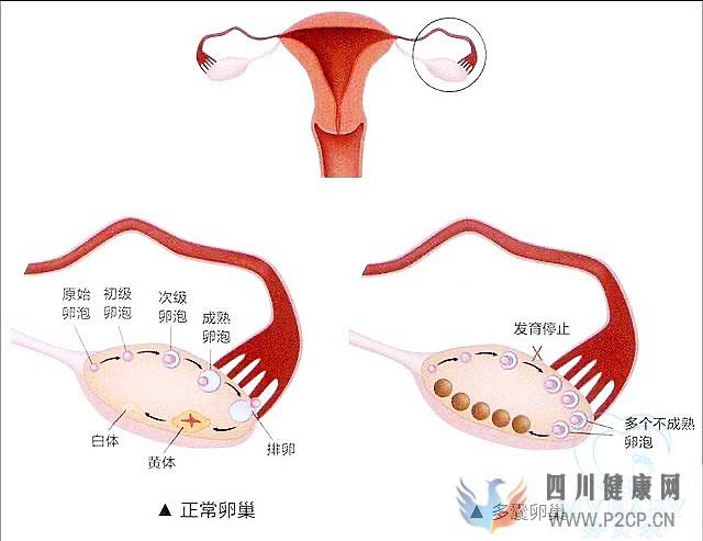 多囊卵巢綜合癥能做試管嬰兒嗎？成功率多少(38歲做試管嬰兒成功率有多少)(圖1)