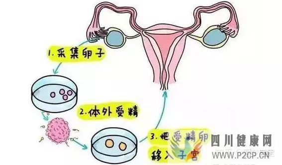 輸卵管通而不暢能做試管嬰兒嗎(女方輸卵管堵塞做試管嬰兒需要多長時間)(圖3)