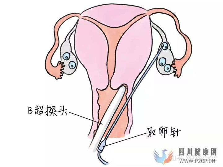 很多人說試管嬰兒可能不會是自己親生的,這是真的...(試管嬰兒90%不是自己的)(圖2) 很多人說試管嬰兒可能不會是自己親生的,這是真的...(試管嬰兒90%不是自己的)(圖2)