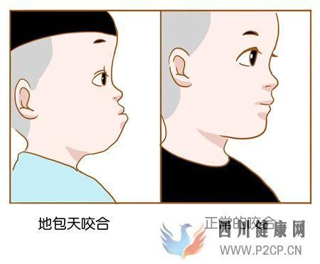 地包天對口腔的影響比你想的要大!(圖1) 地包天對口腔的影響比你想的要大!(圖1)