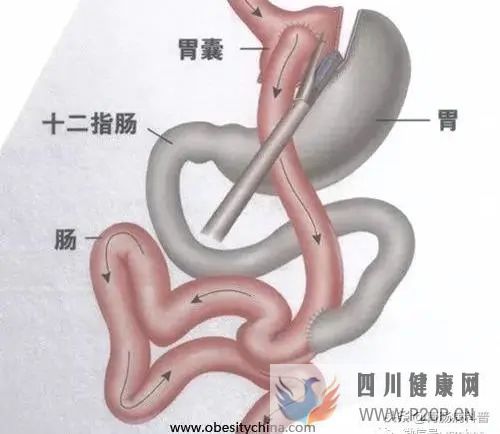 手術也能治糖尿病?一文了解——胃旁路術(圖1) 手術也能治糖尿病?一文了解——胃旁路術(圖1)