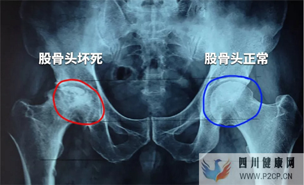 干細胞療法對股骨頭壞死的應用效果與作用機理(干細胞的作用和價格表)(圖1) 干細胞療法對股骨頭壞死的應用效果與作用機理(干細胞的作用和價格表)(圖1)