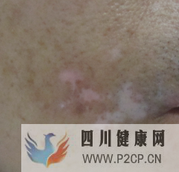 不同時期的白癜風癥狀是什么樣的(圖1) 不同時期的白癜風癥狀是什么樣的(圖1)