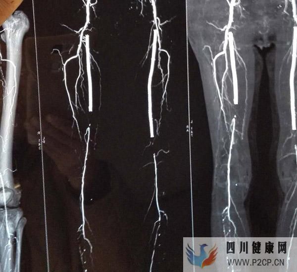 糖尿病并發癥足部潰瘍的早期病因有哪些?(圖1) 糖尿病并發癥足部潰瘍的早期病因有哪些?(圖1)