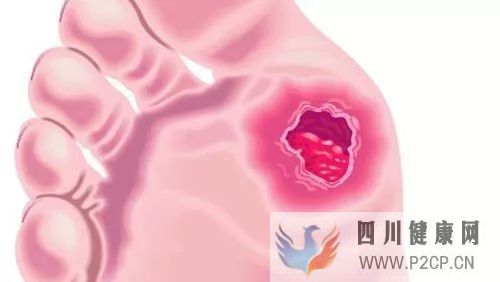 糖尿病出現的爛腳不愈合該怎么治療?(圖1) 糖尿病出現的爛腳不愈合該怎么治療?(圖1)