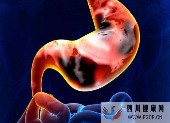 了解胃癌早期癥狀,胃癌發生之前身體有哪些不適癥狀表現(圖1) 了解胃癌早期癥狀,胃癌發生之前身體有哪些不適癥狀表現(圖1)