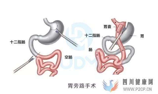 糖尿病能治好嗎?胃旁路手術如何能治療糖尿病?(圖1) 糖尿病能治好嗎?胃旁路手術如何能治療糖尿病?(圖1)