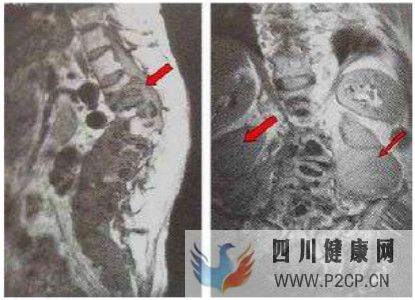 什么是化膿性骨髓炎,化膿性骨髓炎的癥狀有哪些?(圖1) 什么是化膿性骨髓炎,化膿性骨髓炎的癥狀有哪些?(圖1)