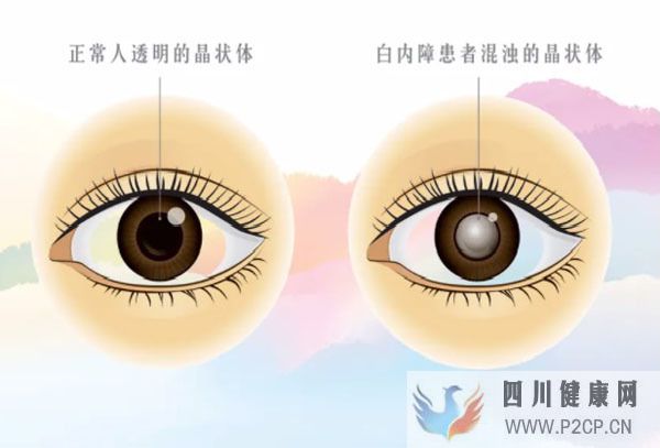 男子眼睛視力下降查出糖尿病，高血糖為何會(huì)傷眼？中醫(yī)辨證療法(圖3)
