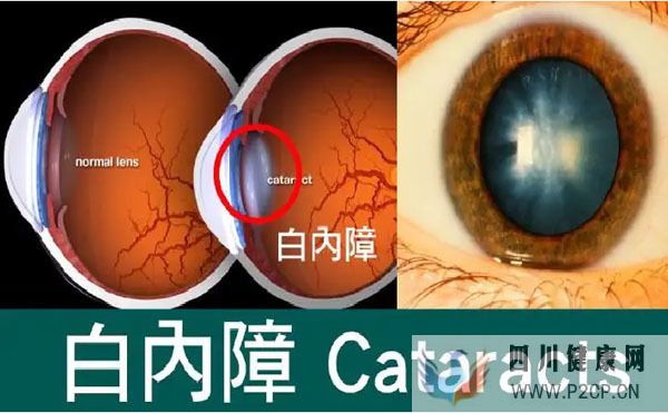 男子眼睛視力下降查出糖尿病，高血糖為何會(huì)傷眼？中醫(yī)辨證療法(圖4)