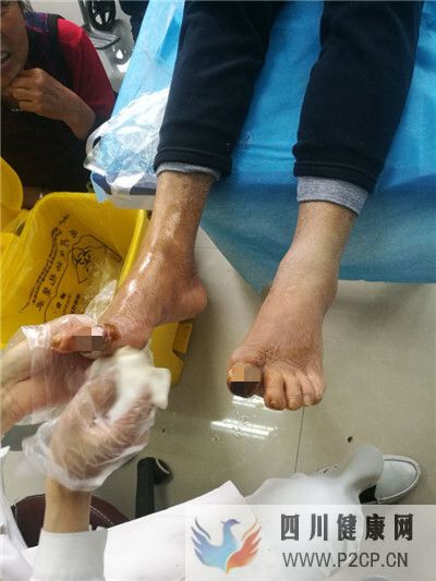 糖尿病患者雙腳大腳趾同時出現發黑潰爛，典型的糖尿病足干性壞疽(圖2)