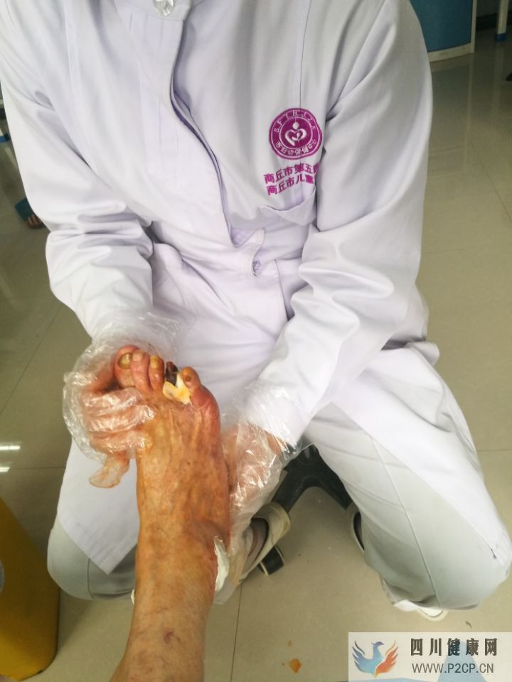 糖尿病患者出現腳趾發黑的現象,是什么原因引起的?(圖1) 糖尿病患者出現腳趾發黑的現象,是什么原因引起的?(圖1)