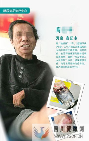 糖尿病患者為什么會得糖尿病足，應該怎么治療？(圖1)