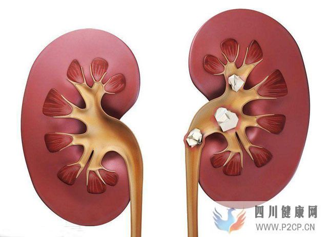 糖尿病患者吃楊桃引發(fā)腎炎,腎病患者哪些蔬菜水果不能吃?(圖1) 糖尿病患者吃楊桃引發(fā)腎炎,腎病患者哪些蔬菜水果不能吃?(圖1)