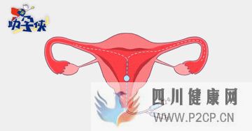 輸卵管不通怎么辦!(圖5) 輸卵管不通怎么辦!(圖5)