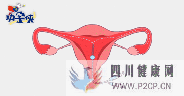 輸卵管不通怎么辦!(圖4) 輸卵管不通怎么辦!(圖4)