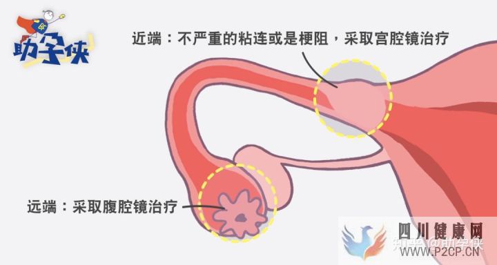 輸卵管不通怎么辦!(圖7) 輸卵管不通怎么辦!(圖7)