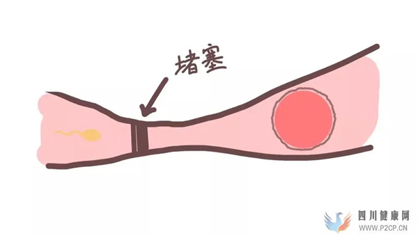 輸卵管堵塞的四個級別(圖1) 輸卵管堵塞的四個級別(圖1)