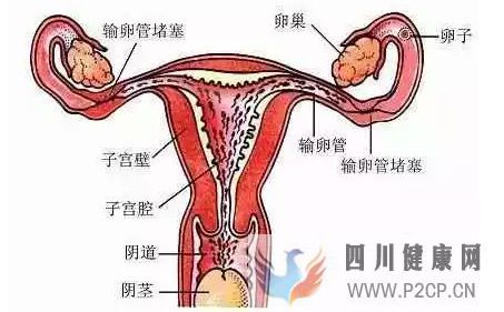 不孕不育輸卵管不孕,女性不孕的最大危害之一!(圖2) 不孕不育輸卵管不孕,女性不孕的最大危害之一!(圖2)