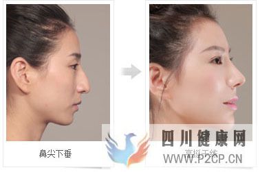 美容整形前一定要知道的美容整形知識(圖6) 美容整形前一定要知道的美容整形知識(圖6)