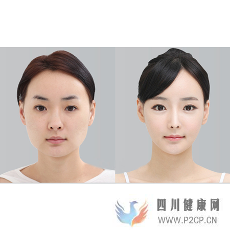 美容整形前一定要知道的美容整形知識(圖7) 美容整形前一定要知道的美容整形知識(圖7)
