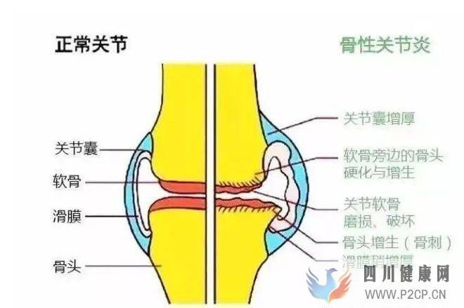 干細胞移植有效治療膝骨關節炎！(圖1)