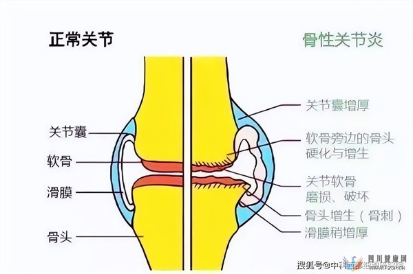 中科西部細胞：干細胞移植有效治療膝骨關節炎！(圖1)