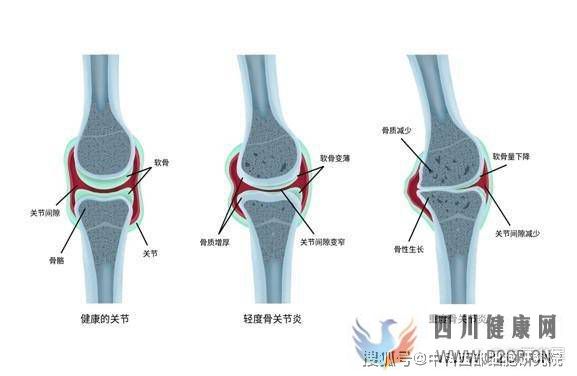 中科西部細胞：干細胞膝關節注射(圖1)