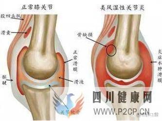 中科西部細胞：干細胞膝關節注射(圖2)