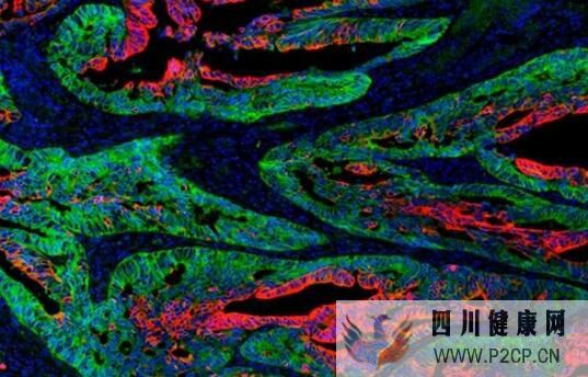 阻斷蛋白質(zhì)的生物合成或有望遏制癌癥干細胞的功能(圖1) 阻斷蛋白質(zhì)的生物合成或有望遏制癌癥干細胞的功能(圖1)
