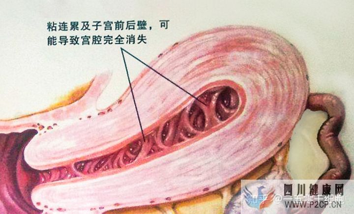 干細胞的4大作用,幫助修復宮腔粘連所致的子宮內膜...(圖2) 干細胞的4大作用,幫助修復宮腔粘連所致的子宮內膜...(圖2)