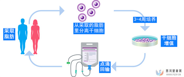 日本干細胞慢性腎臟腎功能不全如何治療日本干細胞治療流程介紹(圖3)